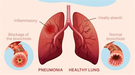 Phases Of Pneumonia