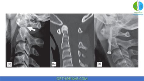 Odontoid Fracture Orthofixar