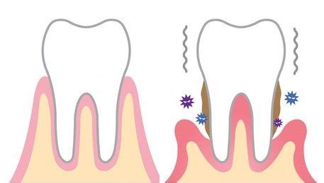 Déchaussement des dents Comprendre Prévenir et Traiter