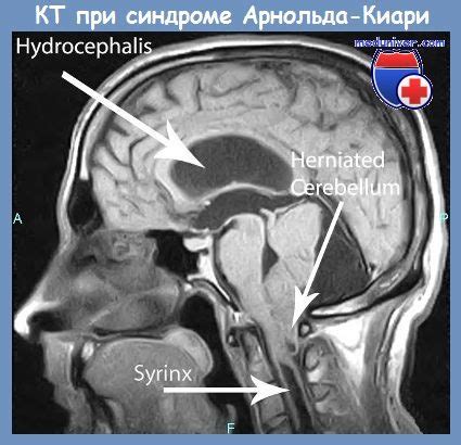 Синдром Арнольда-Киари (Arnold-Chiari) - синонимы, авторы, клиника