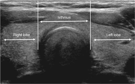 Frontiers Comparison Of Ultrasonography Features And K Tirads For