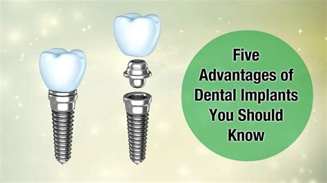 Five Advantages Of Dental Implants You Should Know YouTube