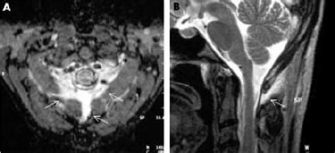 Axial A And Sagittal B T2 Weighted Mri Scan At The Level Of The Download Scientific Diagram