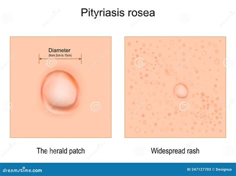 Pityriasis Rosea Skin Rash Coloso