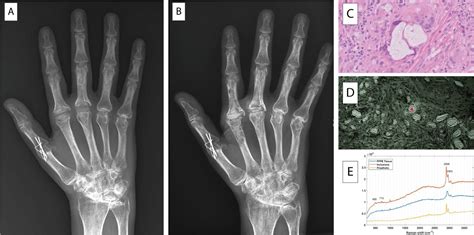 Metacarpophalangeal Joints