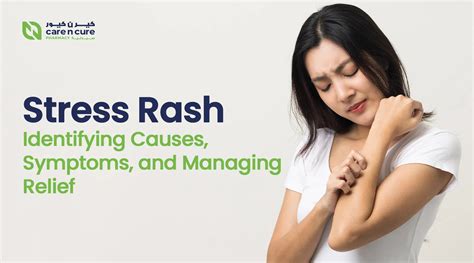 Stress Rash Identifying Causes Symptoms And Managing Relief Care N