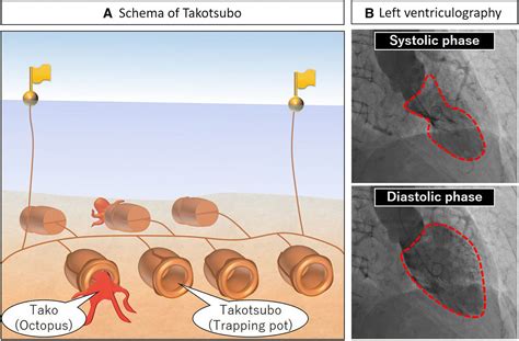 The Role Of Multimodality Imaging In Takotsubo Cardiomyopathy Journal