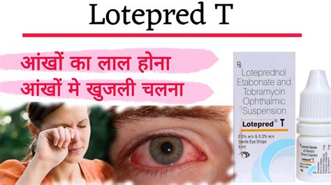 Lotepred T Eye Drop Uses In Hindi Loteprednol Etabonate And