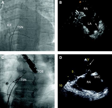 How To Perform A Transseptal Puncture Heart