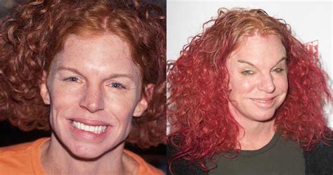 Carrot Top Plastic Surgery