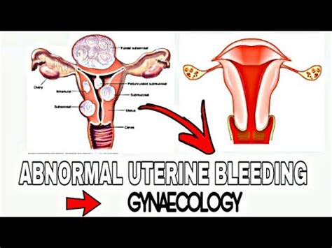 Abnormal Uterine Bleeding Aub Menorrhagia Heavy Menstrual