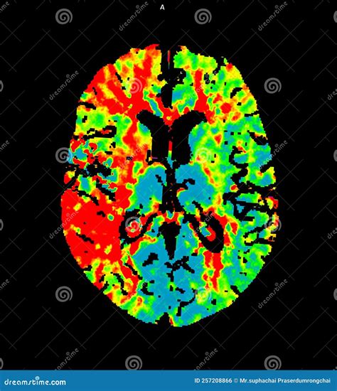 Lobes Of Brain Axial