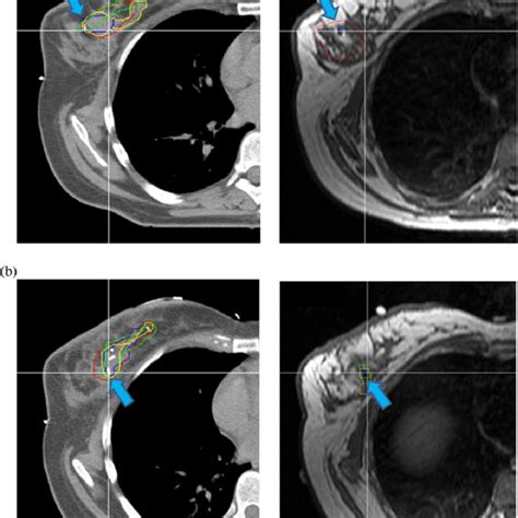 Lumpectomy Cavity Lc Subareolarly Situated Within Dense Glandular