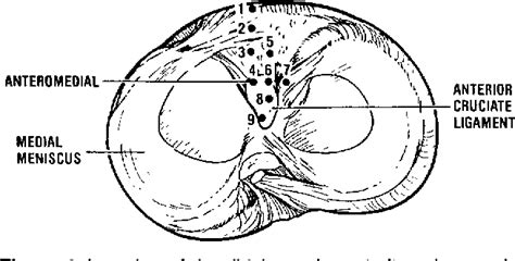 Figure From The Effect Of Tibial Attachment Site On Graft Impingement