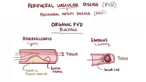 Peripheral Artery Disease Video Anatomy And Definition Osmosis