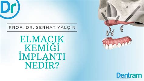 Zygoma Implanti Nedİr Dentram Youtube