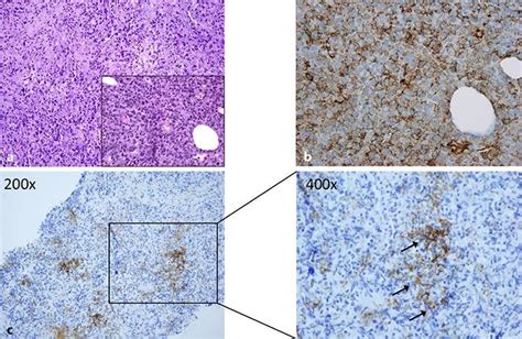 Histopathologic Features Of The Malignant Solitary Fibrous Tumor Of The Download Scientific