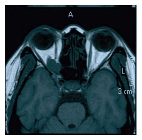 Magnetic Resonance Imaging Of A Patient With Cavernous Hemangioma Of