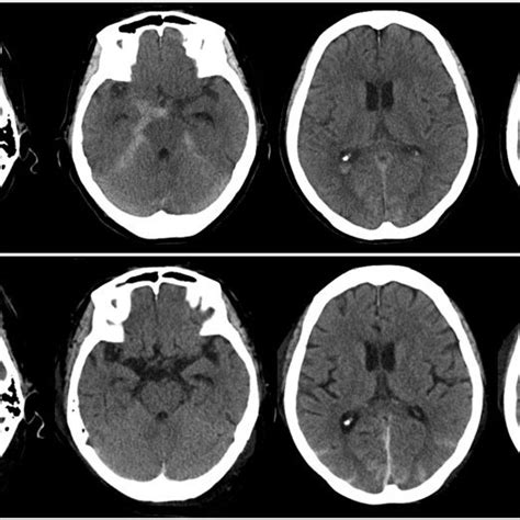 Upper: Initial head CT scan showing subarachnoid hemorrhage in the... | Download Scientific Diagram