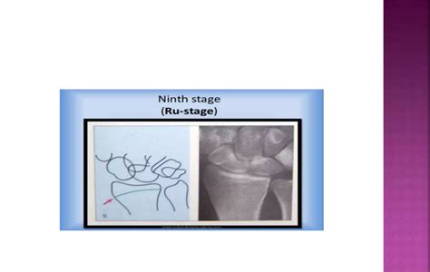 Skeletal Maturity Indicators Pptx Modified Ppt