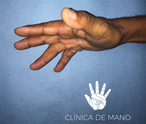 Enfermedad de Dupuytren Clínica de Mano