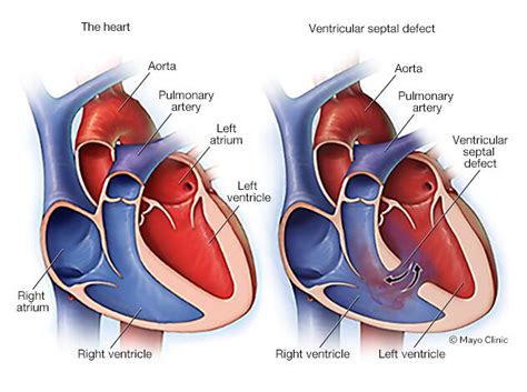 Ventricular Septal Defect Vsd Symptoms And Causes Mayo Clinic