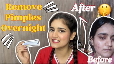 How To Remove Pimples Overnight Secret Cream That Helped Me Remove