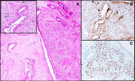 Laparoscopic Resection Of A Large Mixed Epithelial Stromal Tumour Of