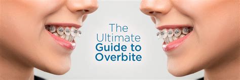 Guide to Overbite: Causes, Symptoms, and Treatment Options