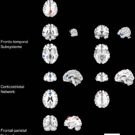 Functional Connectivity Changes In Patients After Weeks Of Treatment