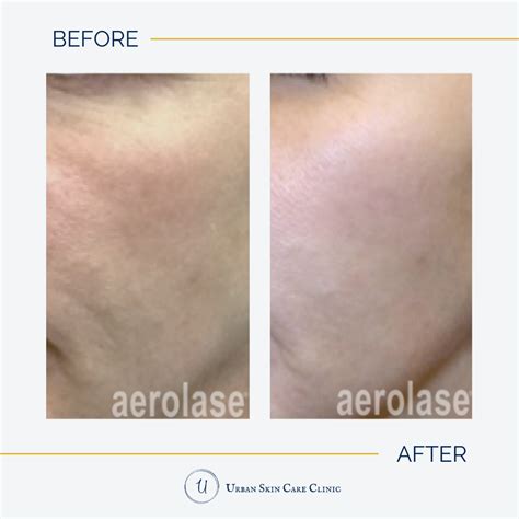 Aerolase Neo Elite Laser Treatment Urban Skin Care Clinic