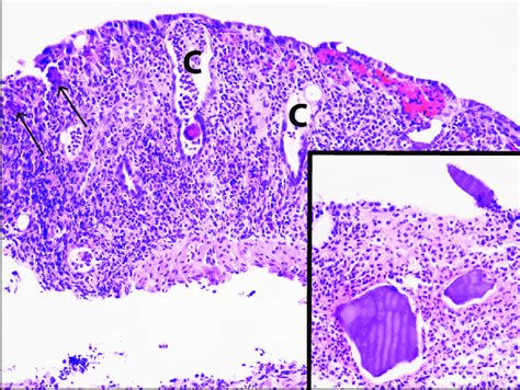 Medium Powered Hematoxylin And Eosin Stain Of Colonic Mucosa Biopsy Download Scientific Diagram