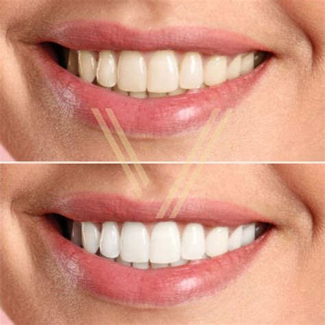 Teeth Whitening In Istanbul Turkey Costs In