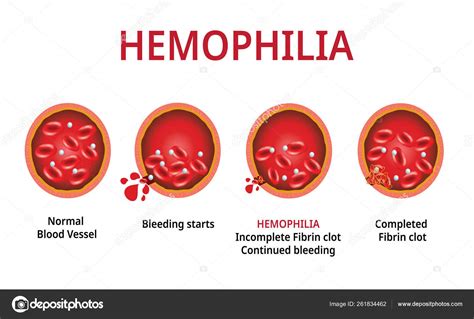 Hemofilia Pti Pdf Hemofilia Enfermedades Y Trastornos Humanos