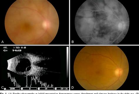 Figure 1 From Intravitreal Bevacizumab Avastin As An Adjuvant For The