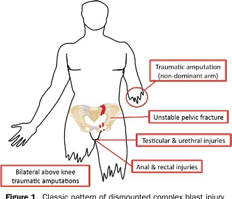 Figure 1 From Dismounted Complex Blast Injuries A Comprehensive Review Of The Modern Combat