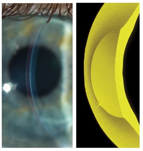 Custom Soft Lenses For Irregular Astigmatism