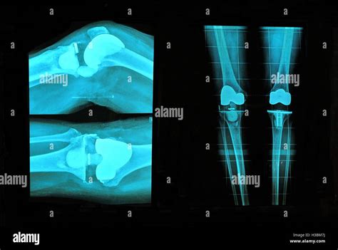 Knee Osteoarthritis Xray Hi Res Stock Photography And Images Alamy