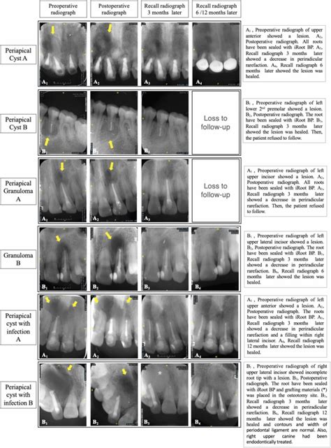 Periapical Granuloma Vs Cyst