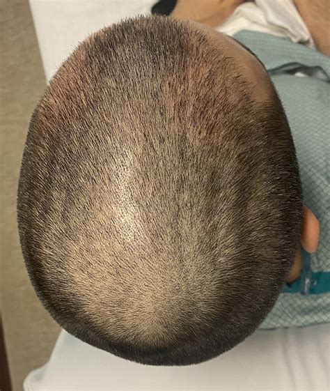 Plastic Surgery Case Study The Trearment Of Scalp Cutis Verticis