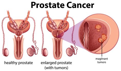 Rak Na Prostati Vzroki In Prvi Simptomi Kak Na Je Napoved Zdravljenja