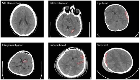 Data Free Full Text Intracranial Hemorrhage Segmentation Using A