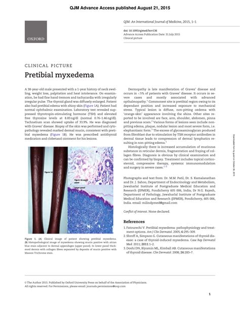 Pdf Pretibial Myxedema