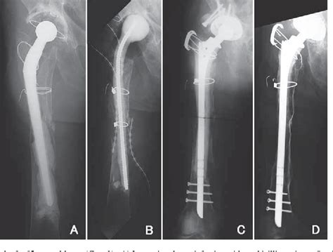 [pdf] Revision Total Hip Arthroplasty Using An Interlocking Stem With An Allograft Prosthesis