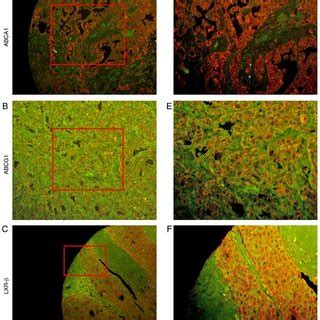 Positive Expression Of Abca Abcg And Lxr In Tnbc Tissues Detected