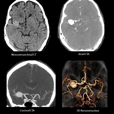 Cerebral Aneurysm Ct