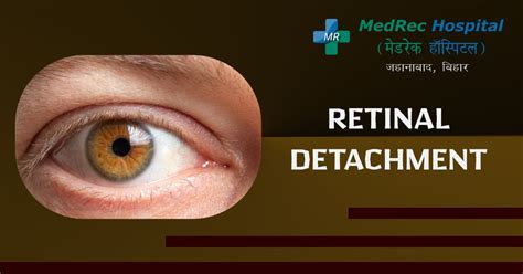 Retinal Detachment Prevention Symptoms And Treatment