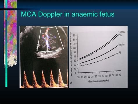 Managing Nonimmune Hydrops Fetalis