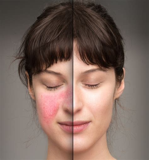 Facing Up To The Skin Condition Called Rosacea