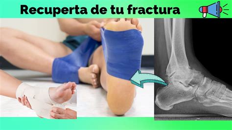 Como Recuperarse R Pido De Una Fractura De Tobillo Crispmoms